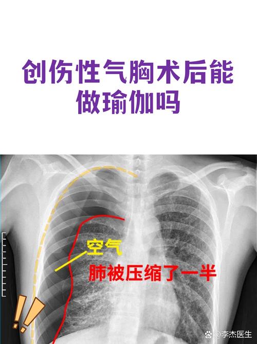 因气胸缺席至今！活塞官方：坎宁安正在康复将在一周后接受复查